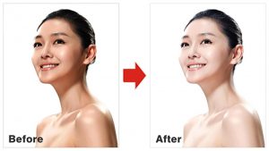 Hình ảnh minh họa trước và sau khi sử dụng Glutathione uống